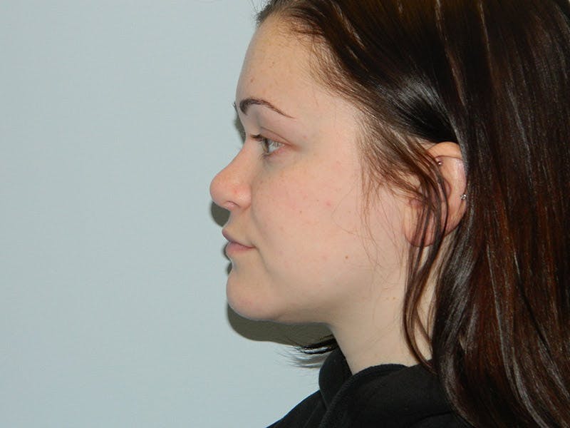 Rhinoplasty Before & After Gallery - Patient 133066661 - Image 4