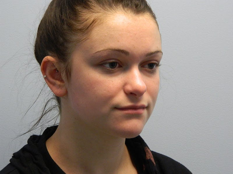 Rhinoplasty Before & After Gallery - Patient 133066661 - Image 5