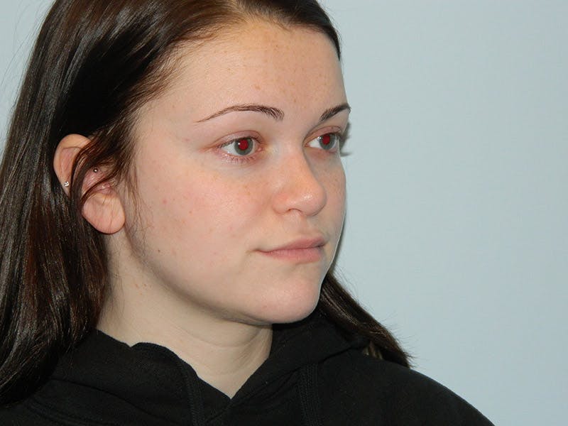 Rhinoplasty Before & After Gallery - Patient 133066661 - Image 6
