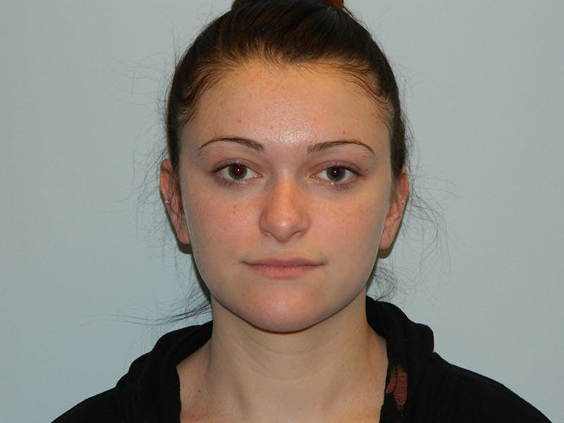 Rhinoplasty Before & After Gallery - Patient 133066661 - Image 7