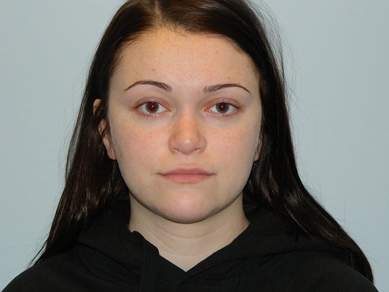 Rhinoplasty Before & After Gallery - Patient 133066661 - Image 8