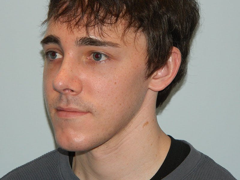 Rhinoplasty Before & After Gallery - Patient 133066667 - Image 4