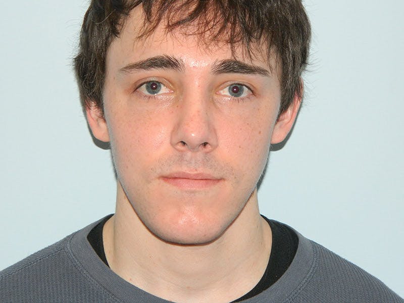 Rhinoplasty Before & After Gallery - Patient 133066667 - Image 6