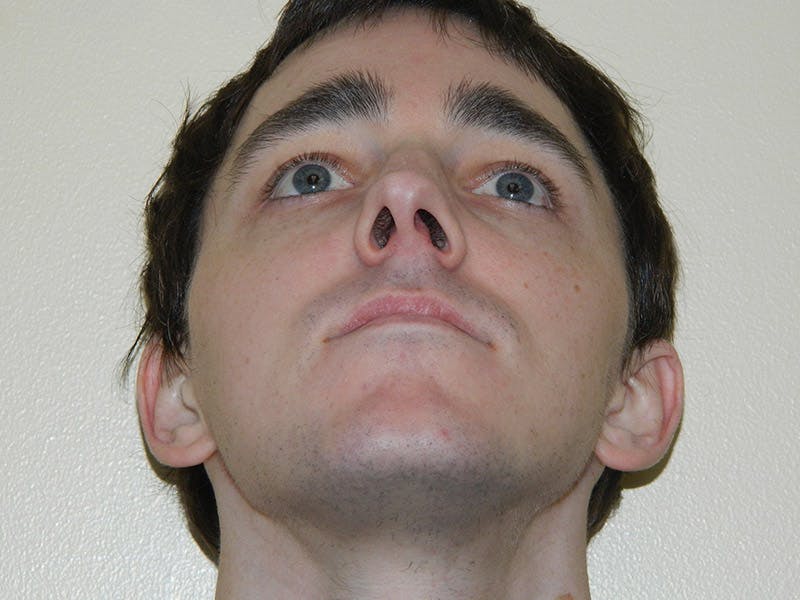 Rhinoplasty Before & After Gallery - Patient 133066667 - Image 7