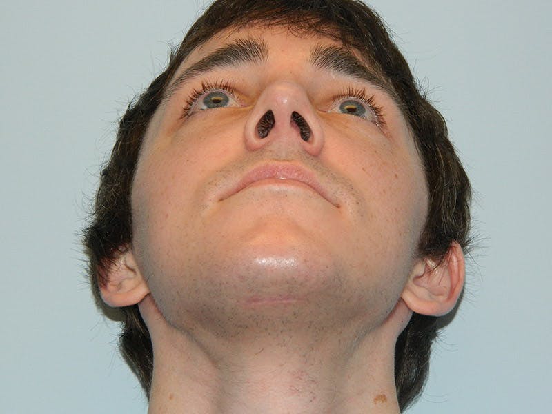 Rhinoplasty Before & After Gallery - Patient 133066667 - Image 8