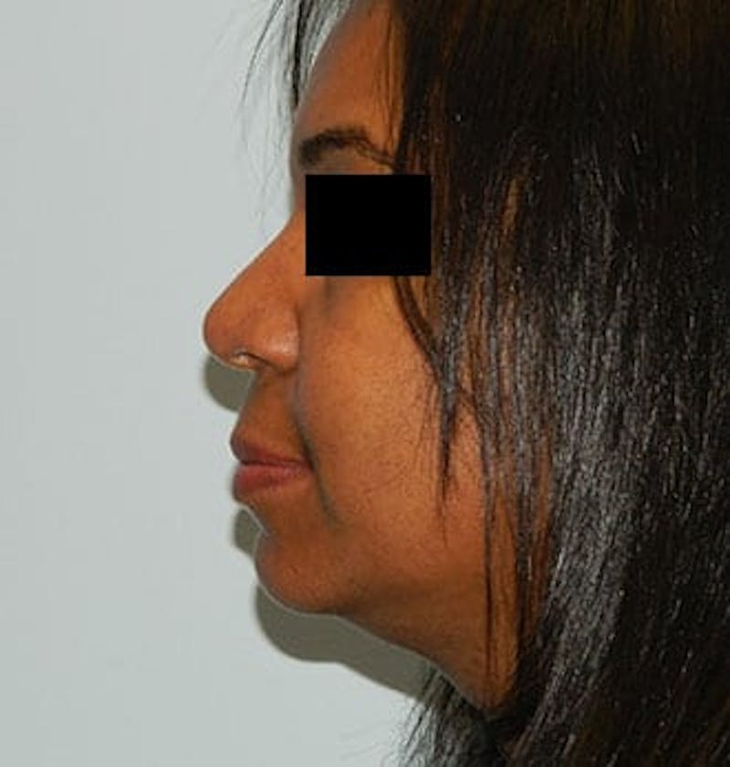 Rhinoplasty Before & After Gallery - Patient 133066668 - Image 1