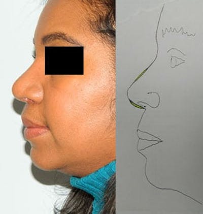 Rhinoplasty Before & After Gallery - Patient 133066668 - Image 2