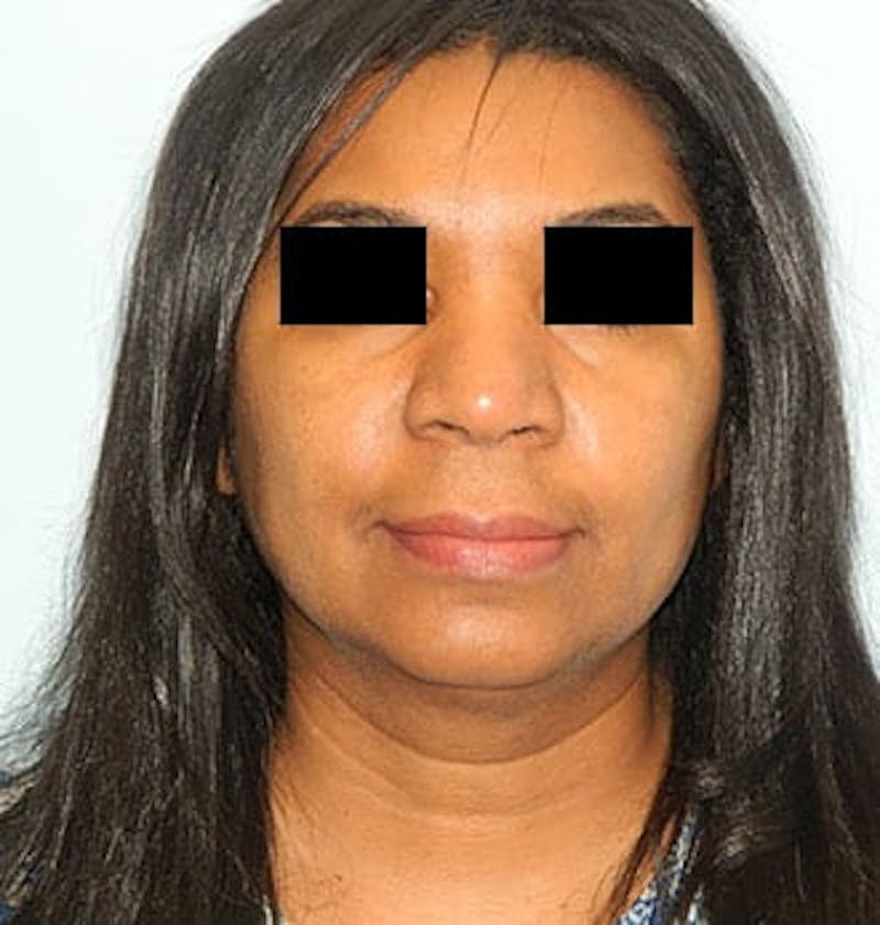 Rhinoplasty Before & After Gallery - Patient 133066668 - Image 3