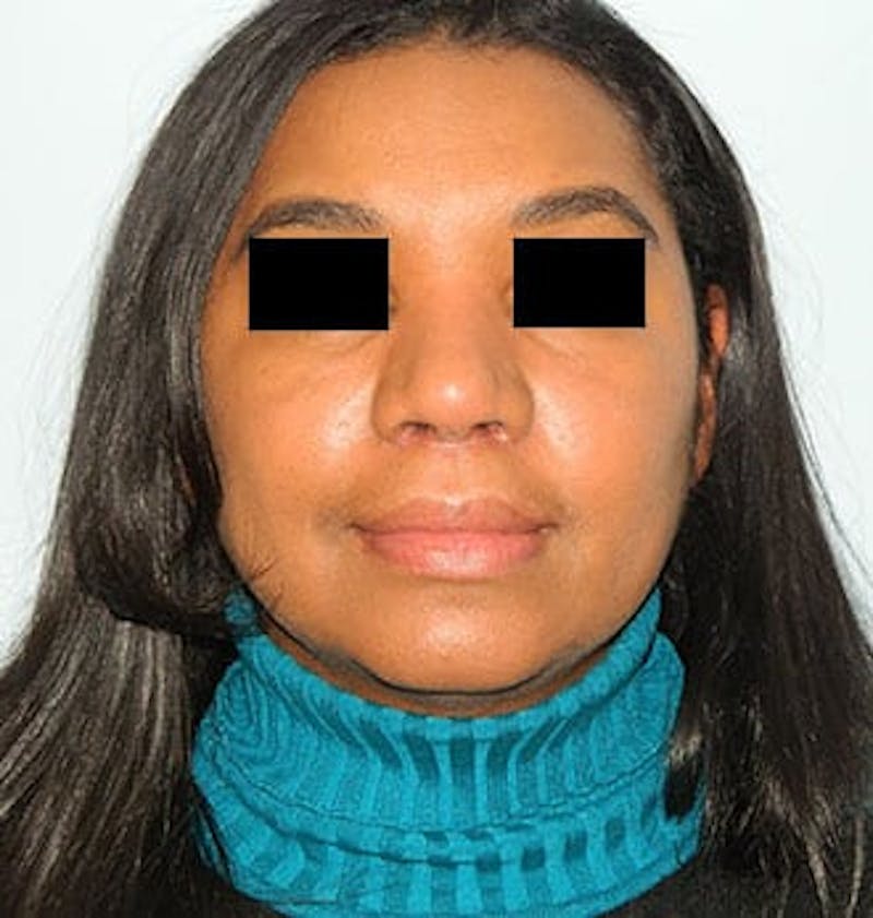 Rhinoplasty Before & After Gallery - Patient 133066668 - Image 4