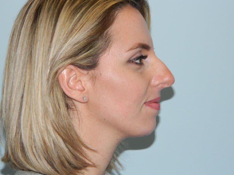Rhinoplasty Before & After Gallery - Patient 133066669 - Image 1