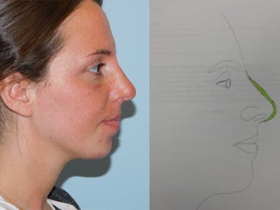 Rhinoplasty Before & After Gallery - Patient 133066669 - Image 2