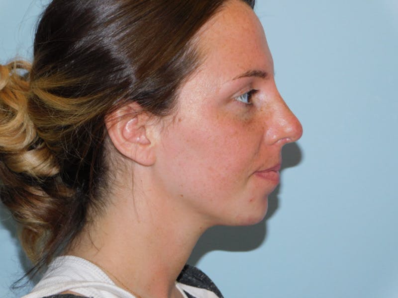 Rhinoplasty Before & After Gallery - Patient 133066669 - Image 4