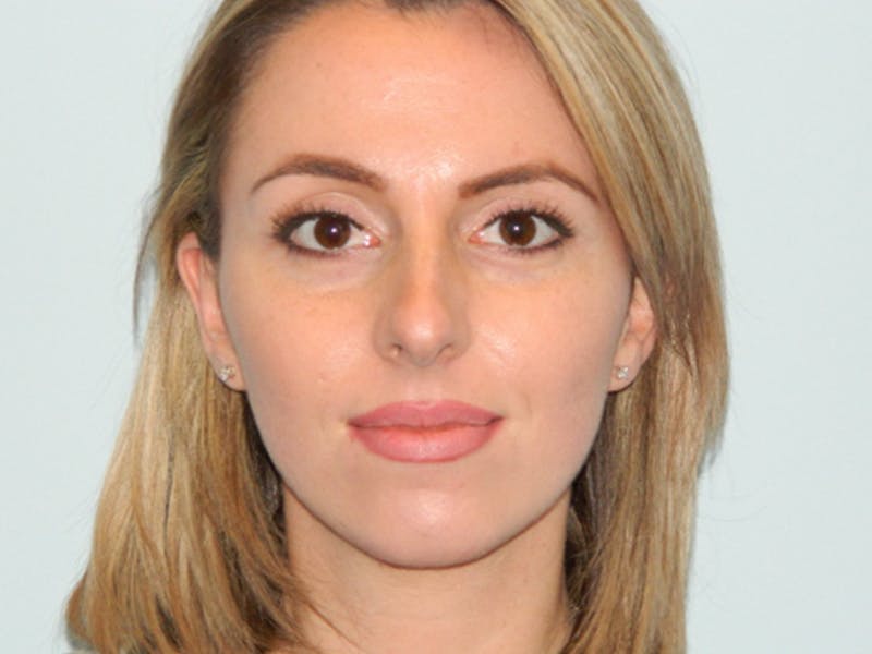 Rhinoplasty Before & After Gallery - Patient 133066669 - Image 5