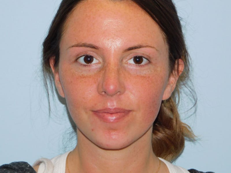Rhinoplasty Before & After Gallery - Patient 133066669 - Image 6