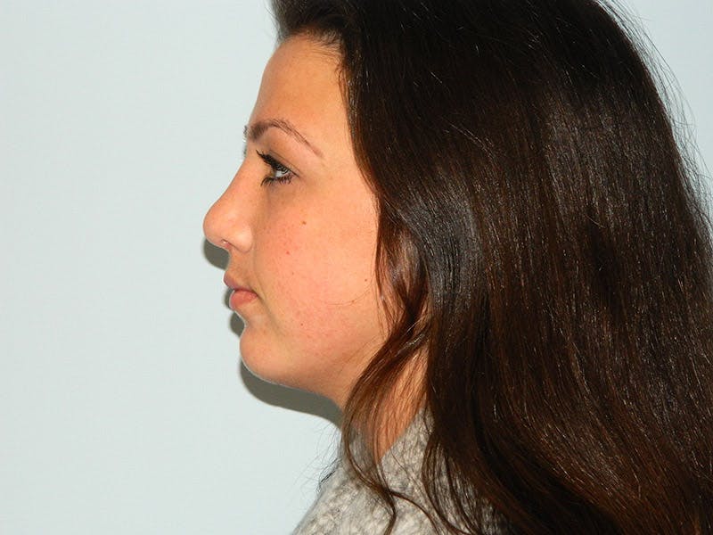 Rhinoplasty Before & After Gallery - Patient 133066672 - Image 4
