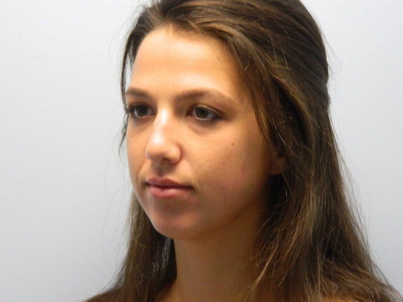 Rhinoplasty Before & After Gallery - Patient 133066672 - Image 5