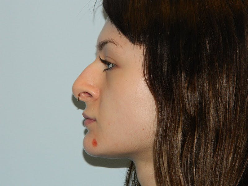 Rhinoplasty Before & After Gallery - Patient 133066673 - Image 1
