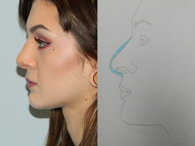 Rhinoplasty Before & After Gallery - Patient 133066673 - Image 2