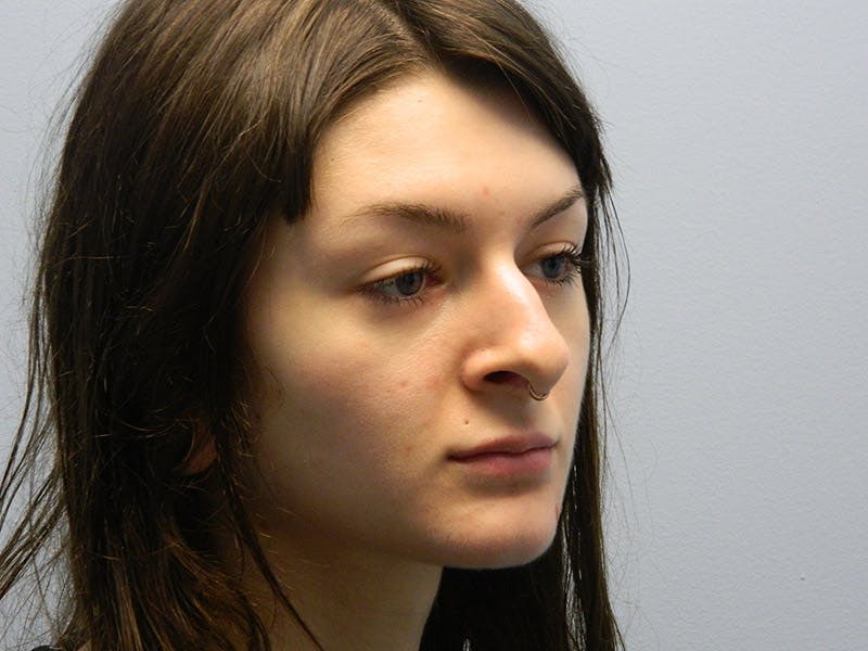 Rhinoplasty Before & After Gallery - Patient 133066673 - Image 3