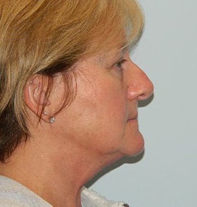 Rhinoplasty Before & After Gallery - Patient 133066676 - Image 1