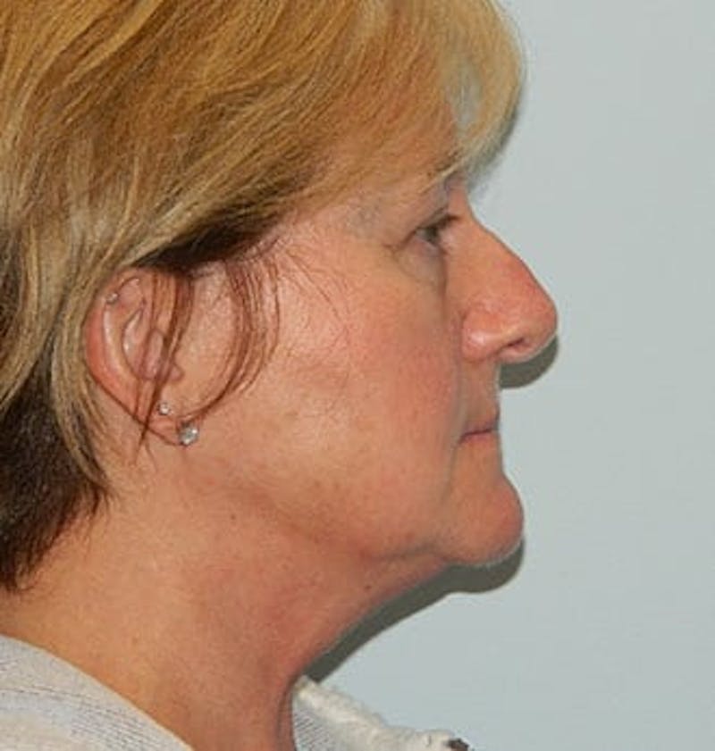Rhinoplasty Before & After Gallery - Patient 133066676 - Image 1