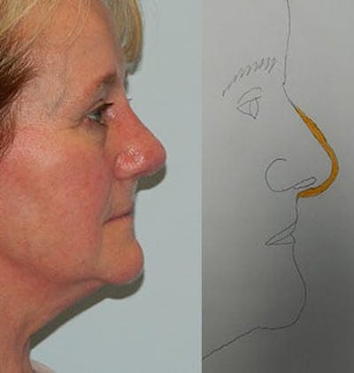Rhinoplasty Before & After Gallery - Patient 133066676 - Image 2