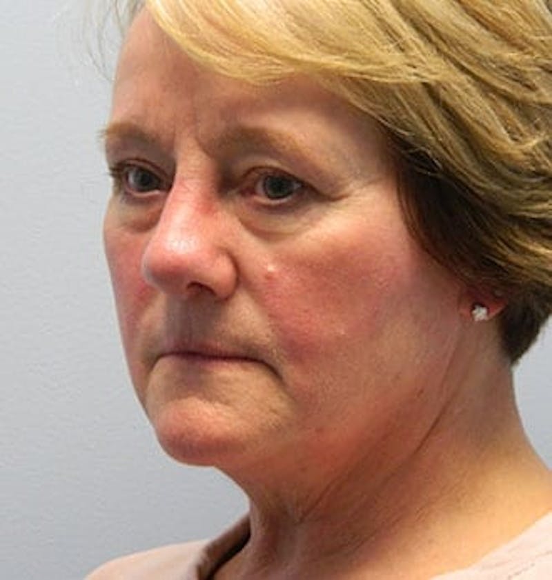 Rhinoplasty Before & After Gallery - Patient 133066676 - Image 4