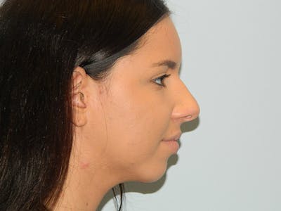 Rhinoplasty Before & After Gallery - Patient 133066677 - Image 1