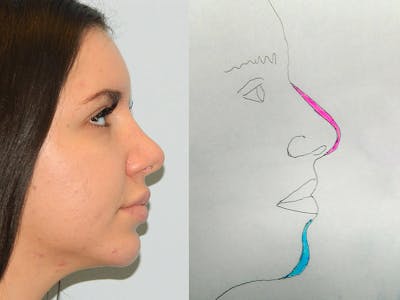 Rhinoplasty Before & After Gallery - Patient 133066677 - Image 2