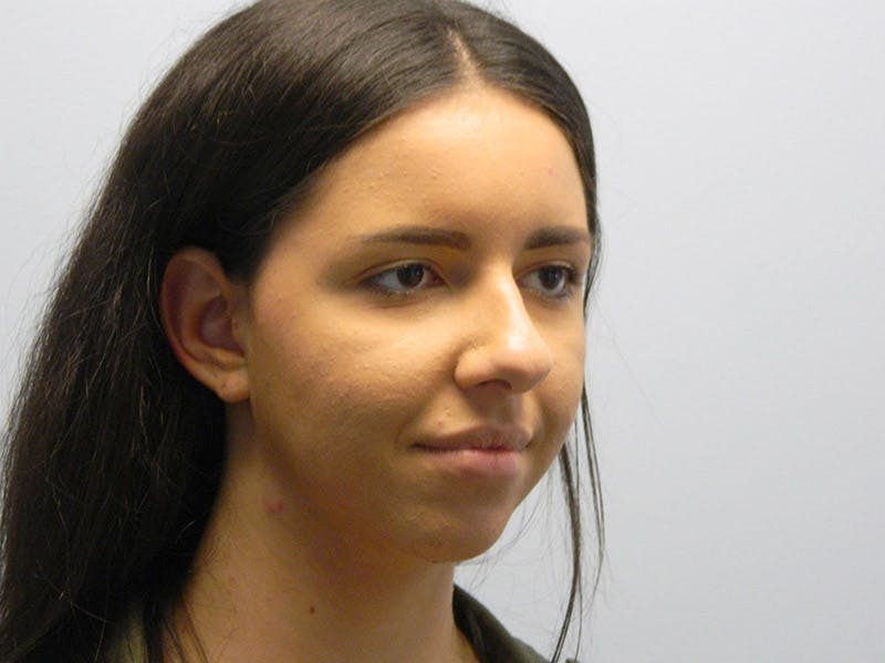Rhinoplasty Before & After Gallery - Patient 133066677 - Image 3