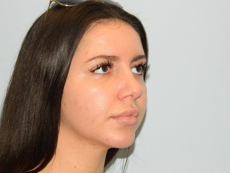 Rhinoplasty Before & After Gallery - Patient 133066677 - Image 4