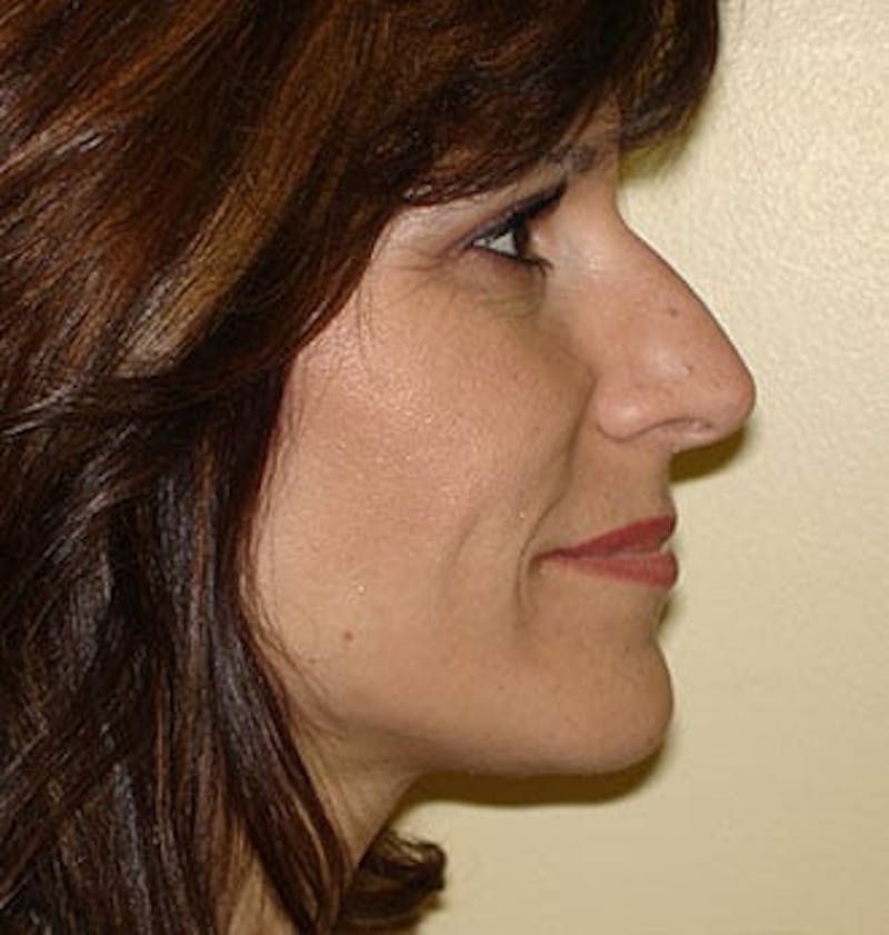 Rhinoplasty Before & After Gallery - Patient 133066682 - Image 1