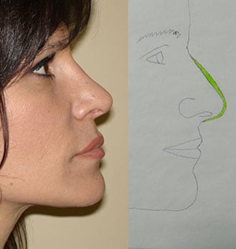 Rhinoplasty Before & After Gallery - Patient 133066682 - Image 2