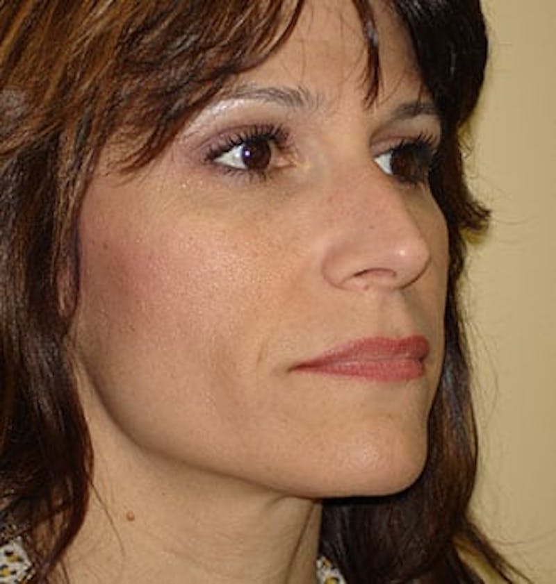 Rhinoplasty Before & After Gallery - Patient 133066682 - Image 3