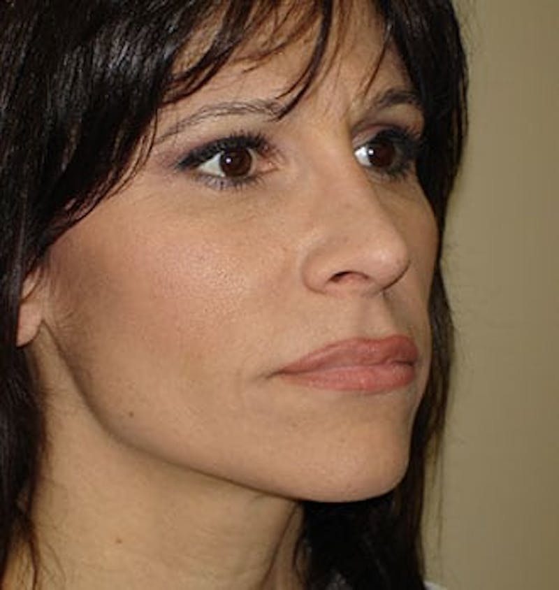 Rhinoplasty Before & After Gallery - Patient 133066682 - Image 4