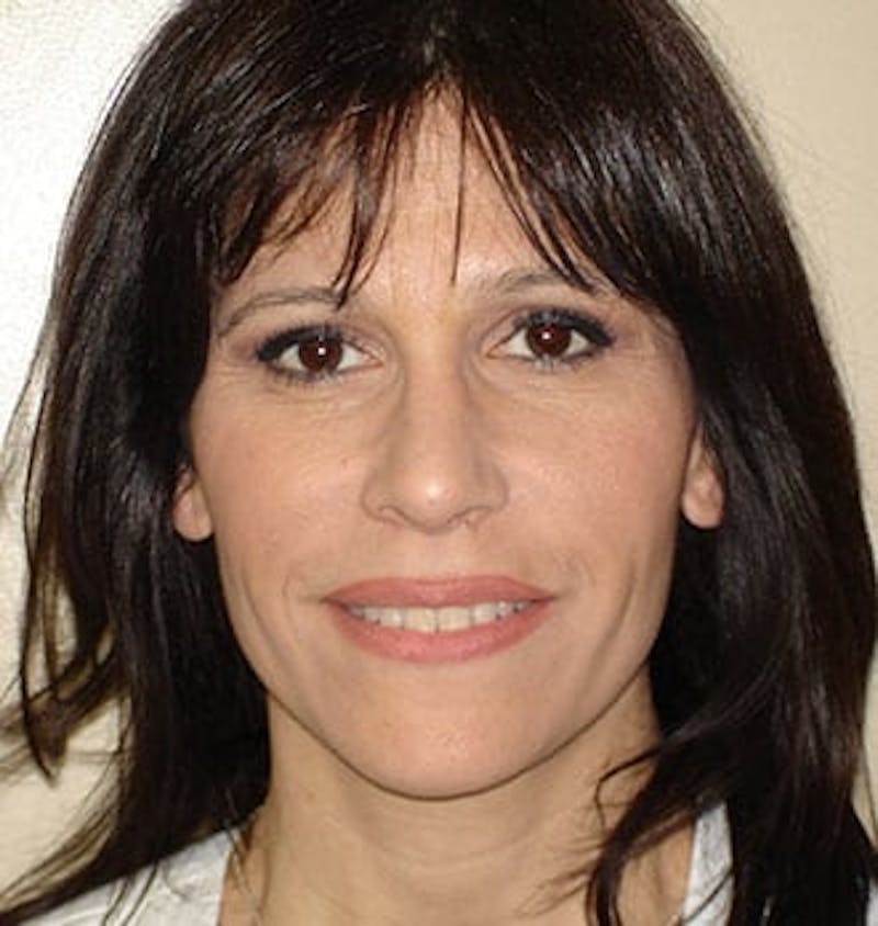 Rhinoplasty Before & After Gallery - Patient 133066682 - Image 6