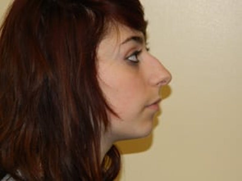 Rhinoplasty Before & After Gallery - Patient 133066684 - Image 1