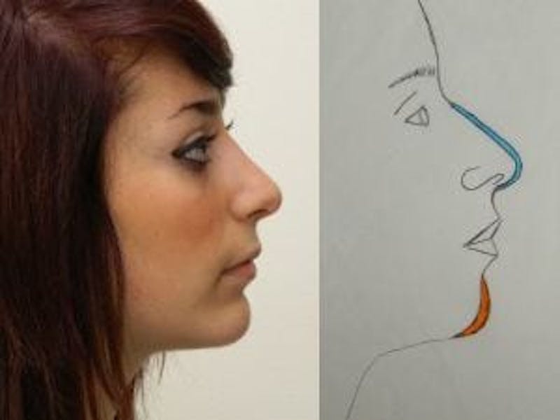 Rhinoplasty Before & After Gallery - Patient 133066684 - Image 2