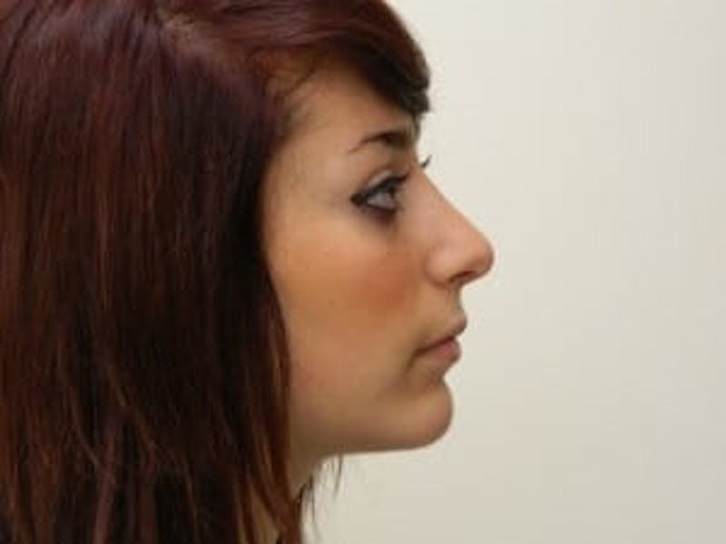 Rhinoplasty Before & After Gallery - Patient 133066684 - Image 4