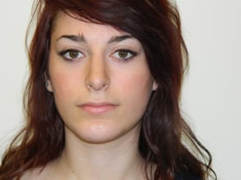 Rhinoplasty Before & After Gallery - Patient 133066684 - Image 8