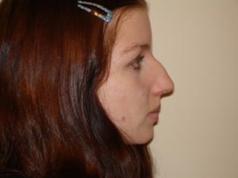 Rhinoplasty Before & After Gallery - Patient 133066696 - Image 1