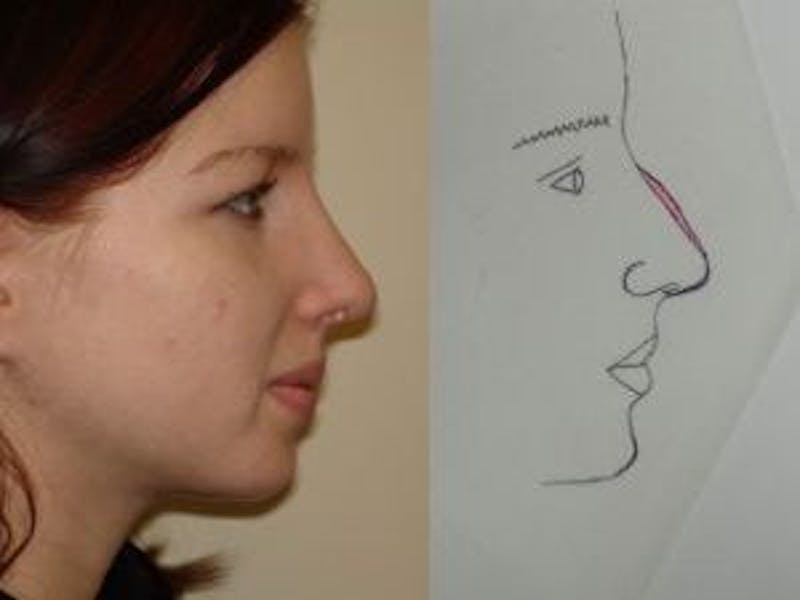 Rhinoplasty Before & After Gallery - Patient 133066696 - Image 2
