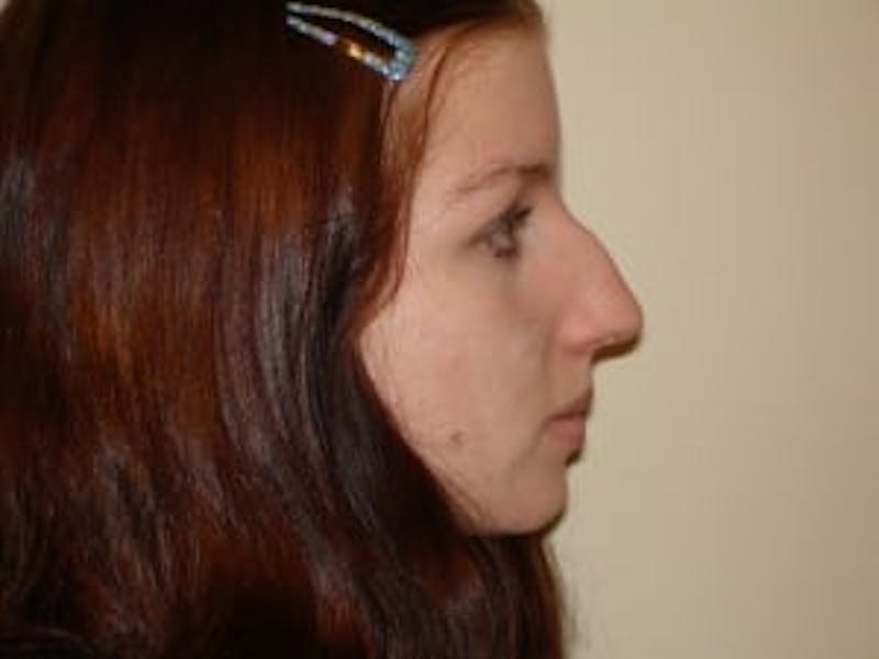 Rhinoplasty Before & After Gallery - Patient 133066696 - Image 3