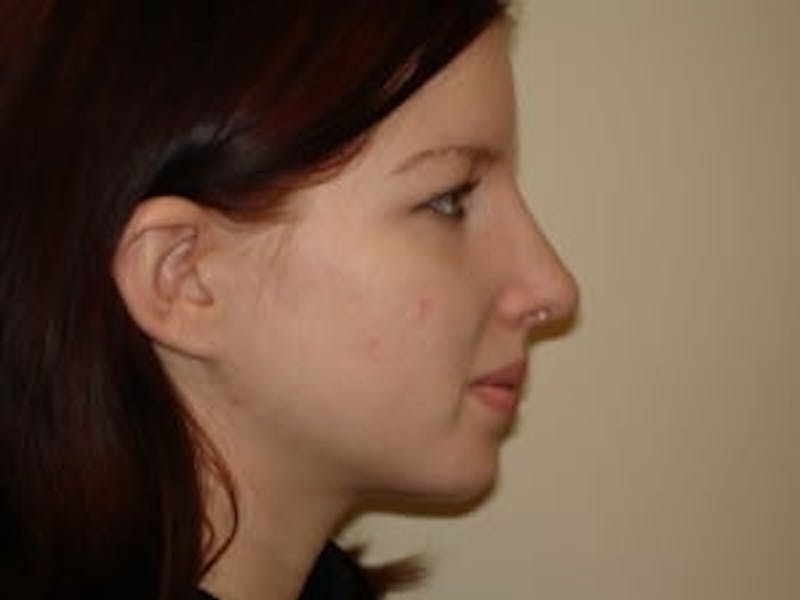 Rhinoplasty Before & After Gallery - Patient 133066696 - Image 4