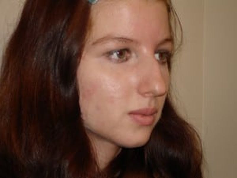 Rhinoplasty Before & After Gallery - Patient 133066696 - Image 5