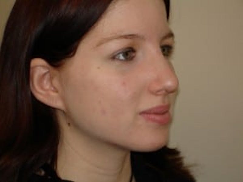 Rhinoplasty Before & After Gallery - Patient 133066696 - Image 6