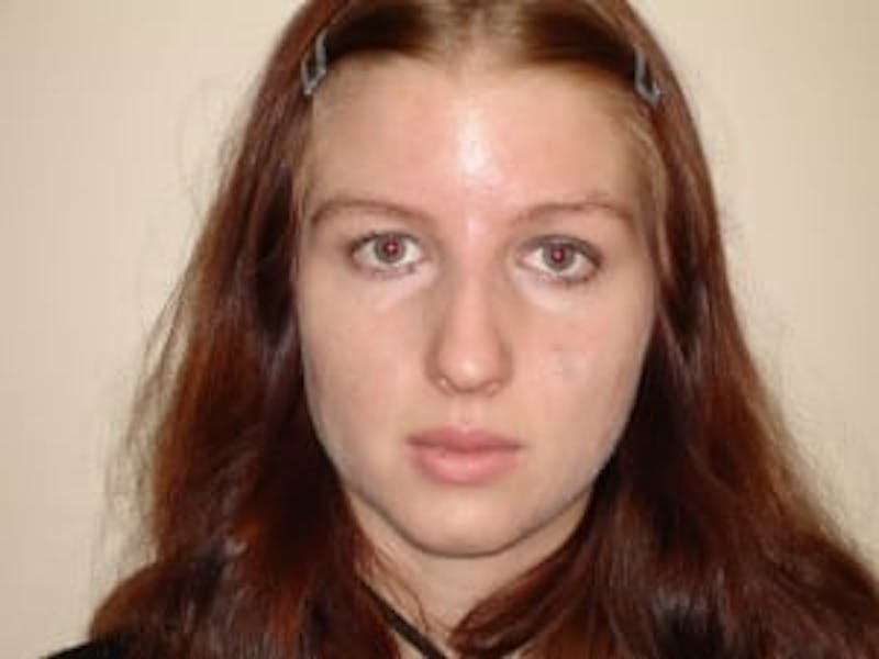 Rhinoplasty Before & After Gallery - Patient 133066696 - Image 7