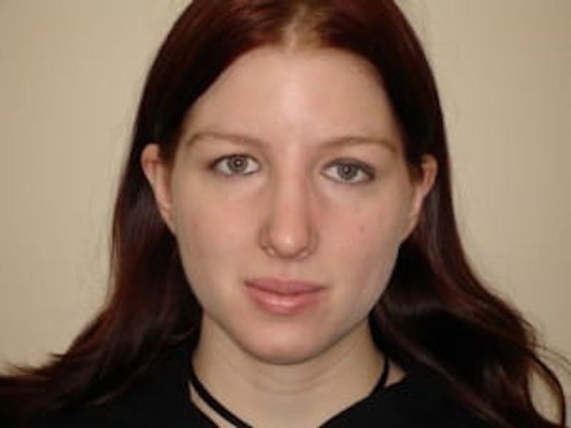 Rhinoplasty Before & After Gallery - Patient 133066696 - Image 8