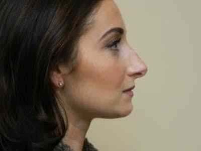 Rhinoplasty Before & After Gallery - Patient 133066697 - Image 1