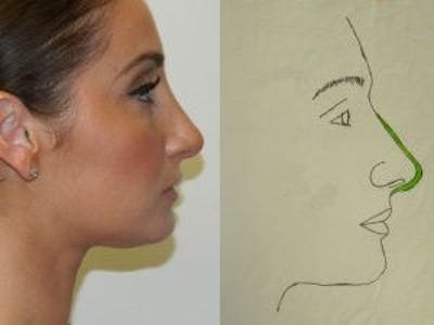 Rhinoplasty Before & After Gallery - Patient 133066697 - Image 2